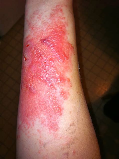 Why is my poison ivy rash spreading?