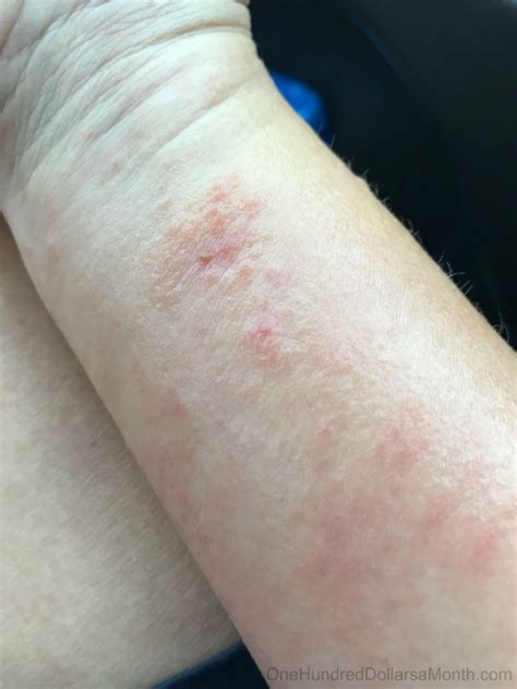 Why is my poison ivy rash still spreading after a week?
