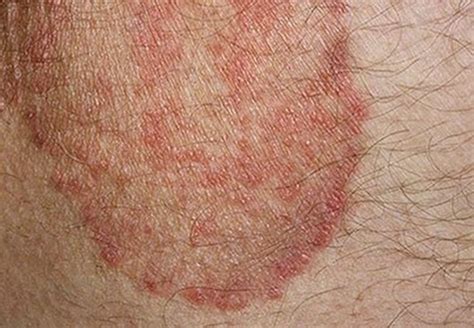 Why is my rash turning brown after healing?