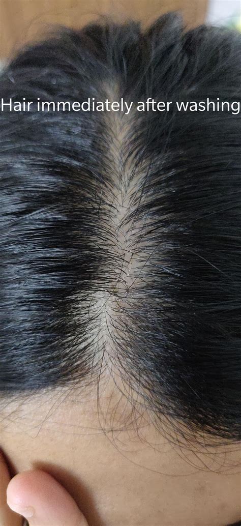 Why is my scalp white after washing?