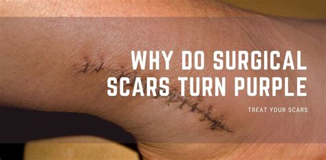 Why is my scar still purple?