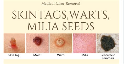 Why is my skin tag getting bigger?