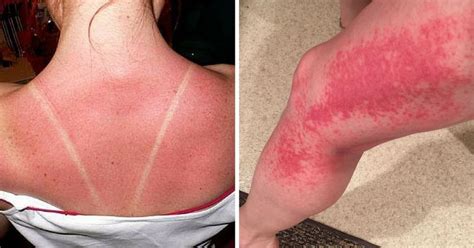 Why is my sunburn uncontrollably itchy?