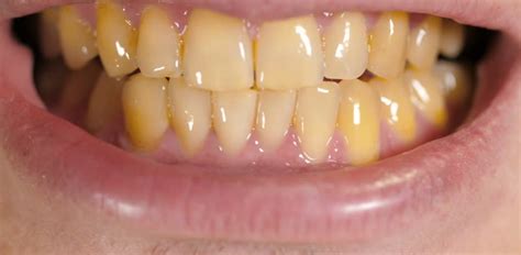 Why is my teeth getting yellow?