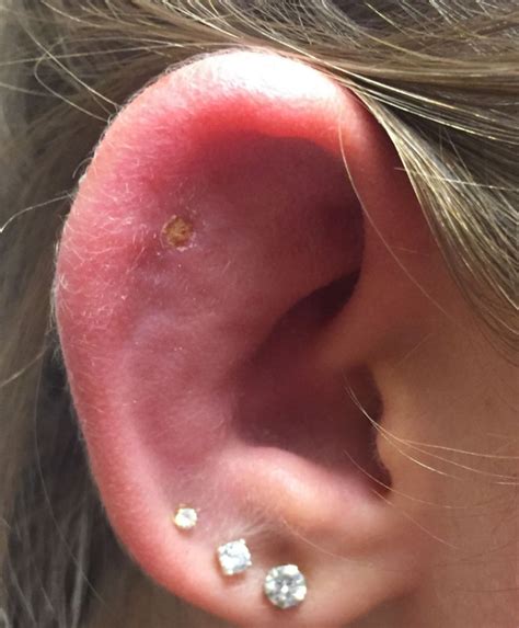 Why is pus coming out of my ear piercing?