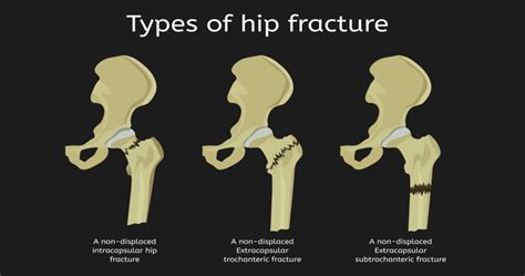 Why is the hip so stable?