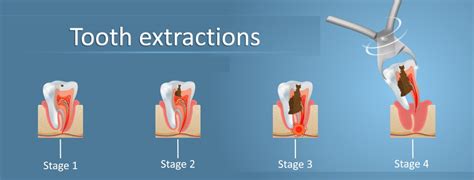 Why is the hole in my tooth extraction not closing?