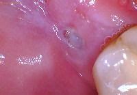 Why is there a hole in my gum behind my molar?