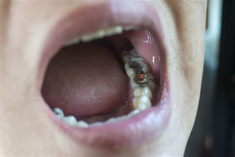 Why is tooth infection so painful?