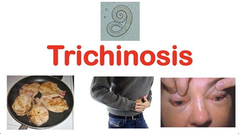 Why is trichinosis bad?