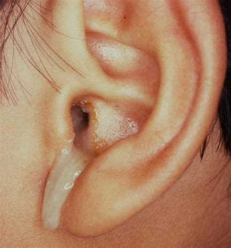 Why my ear is leaking with oil?