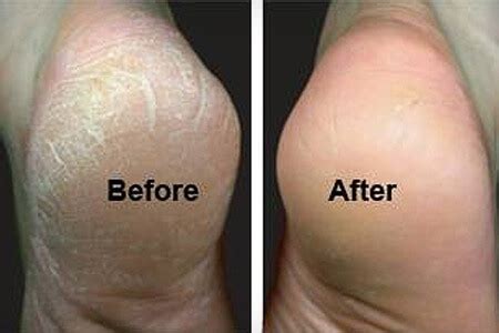 Why should you not cut calluses?