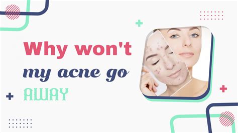 Why won't my acne cyst go away?