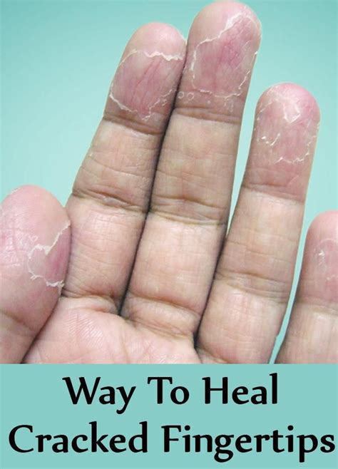 Why won't my cracked fingers heal?
