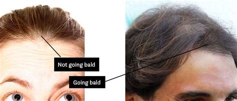 Will I go bald if I have thin hair?