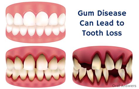 Will I lose all my teeth if I have gum disease?