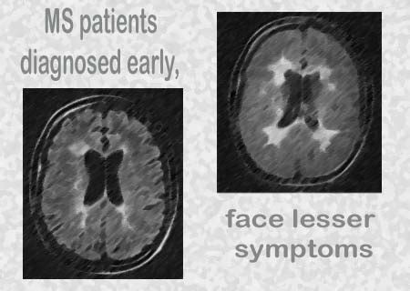 Will MS always show up on MRI?