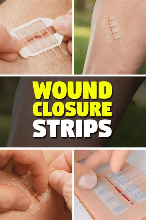 Will a deep cut close without stitches?