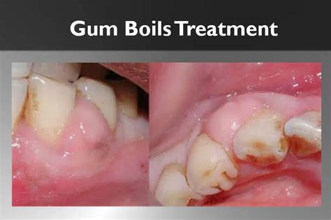 Will a gum boil heal itself?