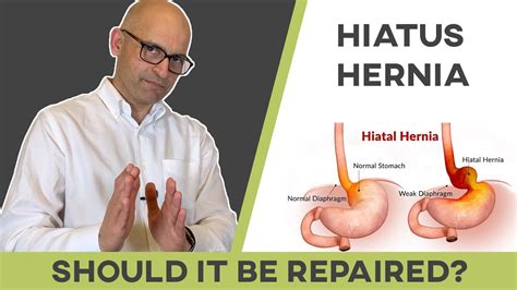 Will a hiatal hernia go away if you lose weight?