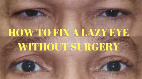 Will a lazy eye correct itself?
