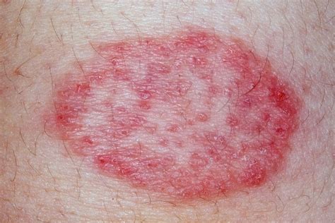 Will a rash go away on its own?