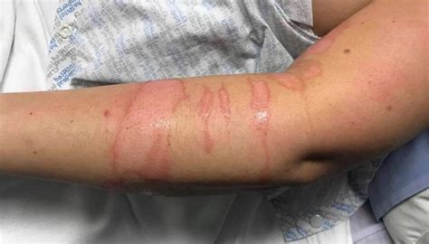 Will a second-degree burn leave a scar?