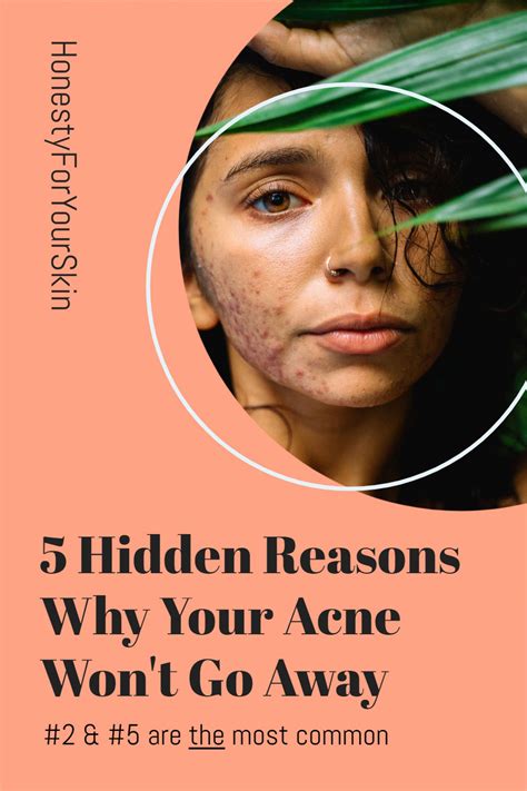 Will acne go away if you leave it alone?