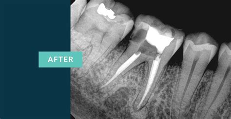 Will an xray show a failed root canal?