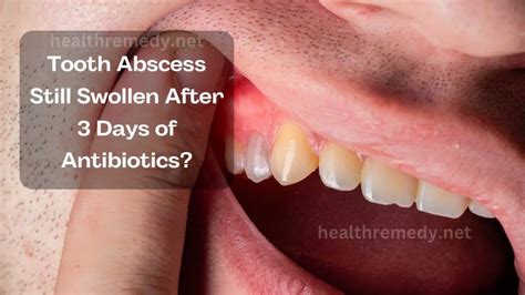 Will antibiotics reduce swelling abscess?
