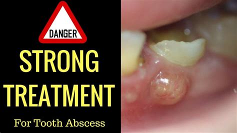 Will antibiotics shrink a tooth abscess?