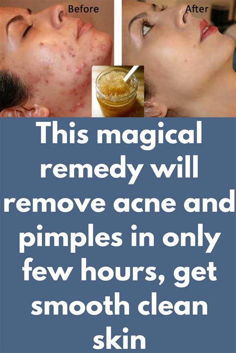 Will back acne go away naturally?