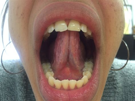 Will cutting my frenulum make my tongue longer?