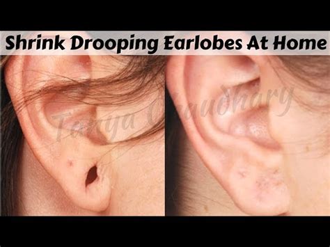 Will earlobe holes close?