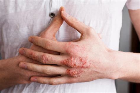 Will eczema go away if you don't scratch?