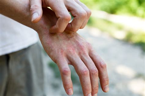 Will eczema go away without steroids?