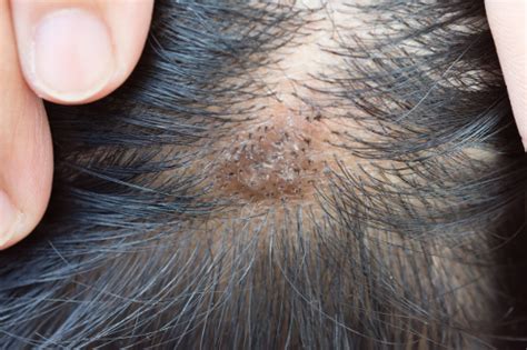 Will hair grow over scabs?