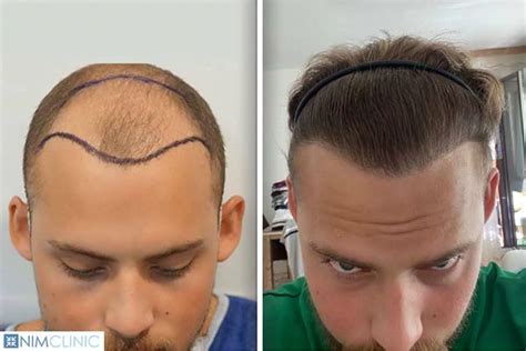 Will hair transplants get better in the future?