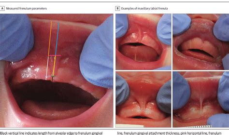 Will lip frenulum grow back?