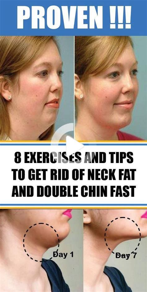 Will losing weight make my neck look better?