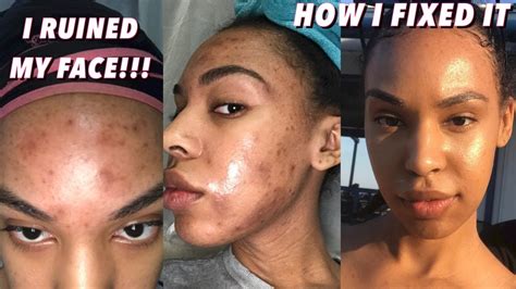 Will melanin come back after a burn?