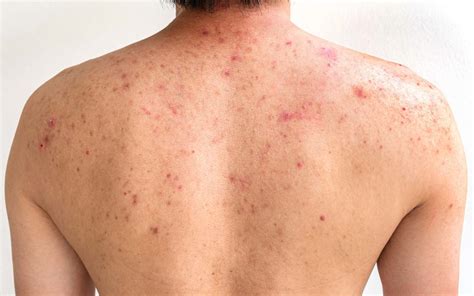 Will my back acne scar?