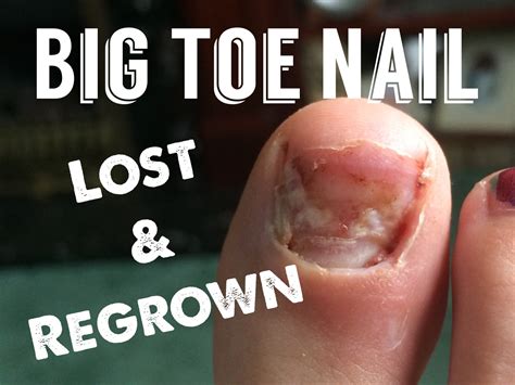 Will my big toe nail grow back?