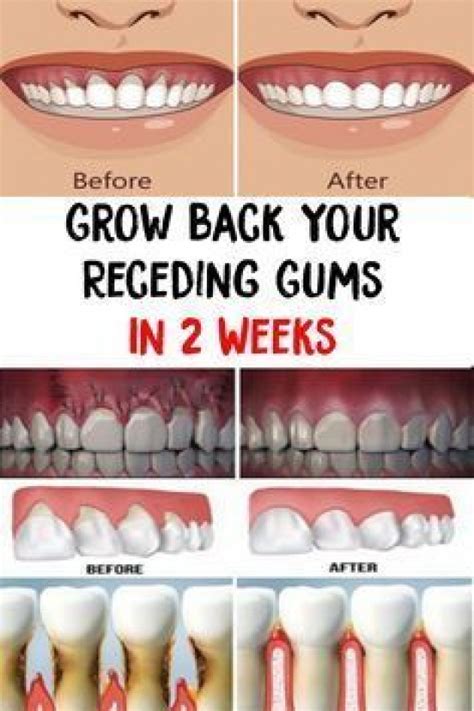 Will my gums grow back after deep cleaning?
