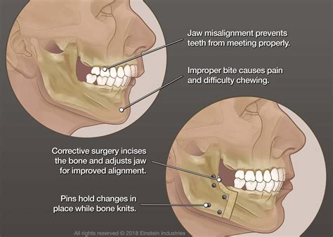 Will my jaw realign after wisdom teeth removal?