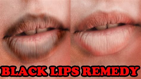 Will my lips stay black from smoking?
