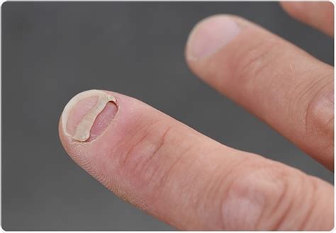 Will my nail ever heal?