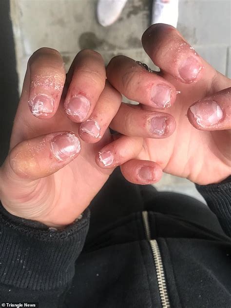 Will my nails stop hurting after acrylics?