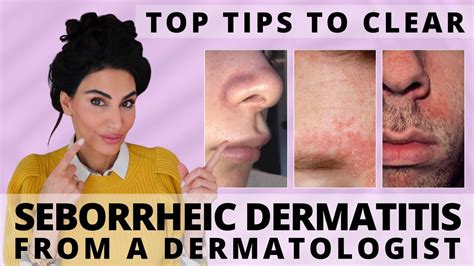 Will my seborrheic dermatitis ever clear up?