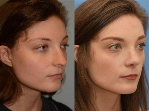 Will nose breathing change my face?